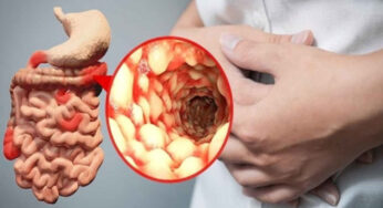 Crohn Hastalığı Belirtileri ve Tedavisi