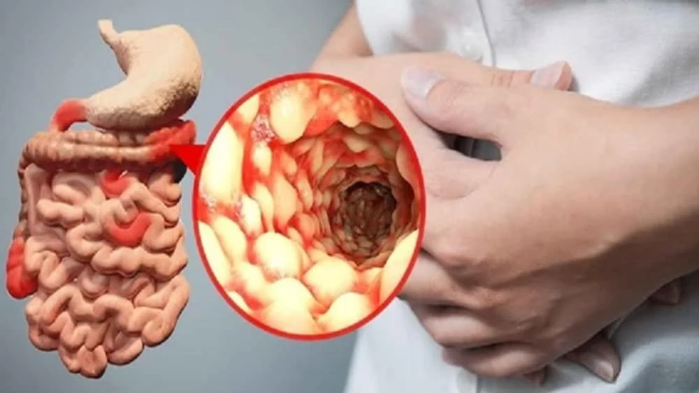 Crohn Hastalığı belirtileri