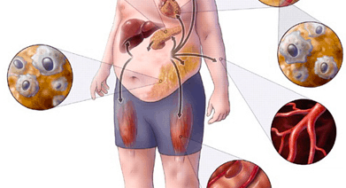 Metabolik Sendrom Nedir? Belirtileri Neler?