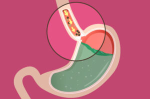 asit reflüsü belirtileri