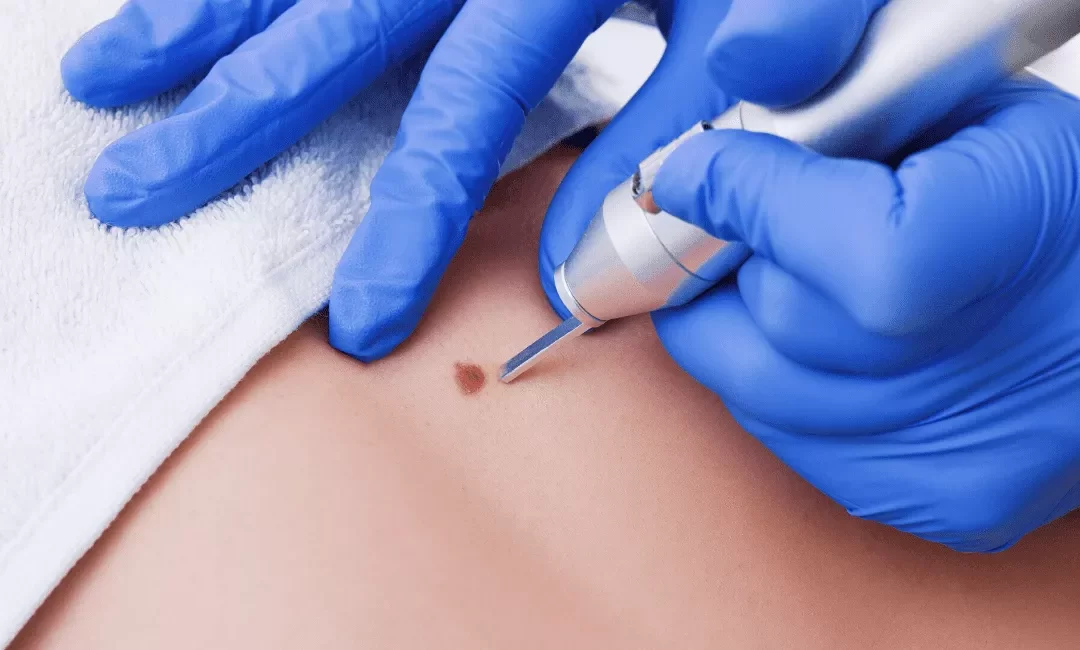 Kriyoterapi Nedir? Soğuk Terapi