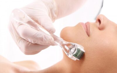 Microneedling Nedir? Mikro İğneleme