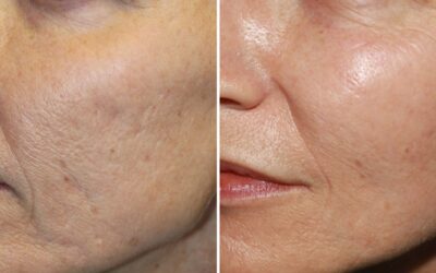 Dermapen ve Mezoterapi Farkı Nedir?