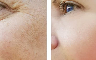 Skinbooster Nedir? Skin Booster Uygulaması