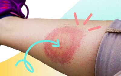 Lyme hastalığı Ölümcül mü? Evreleri Neler?