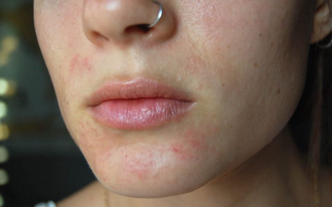 Perioral dermatit tedavisi