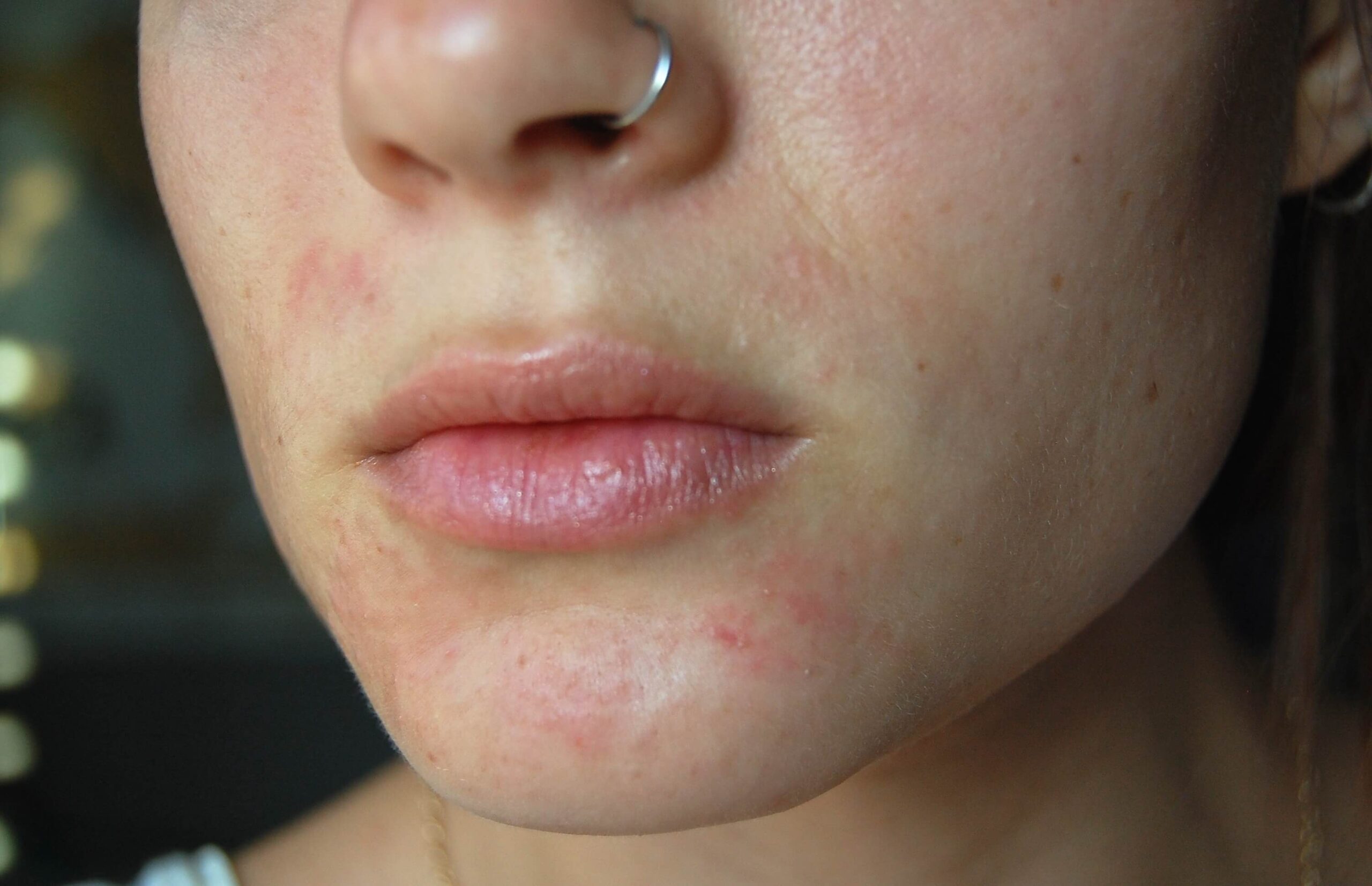 Perioral dermatit tedavisi