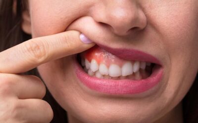 Diş Eti Şişkinliğine Ne İyi Gelir? Doğal Çözümler