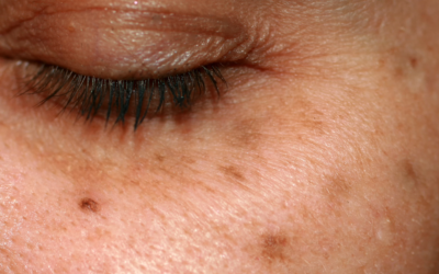 Güneş Lekeleri Nasıl Geçer?