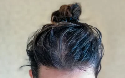 Kafada Sivilce Çıkması Neden Olur, Nasıl Geçer?