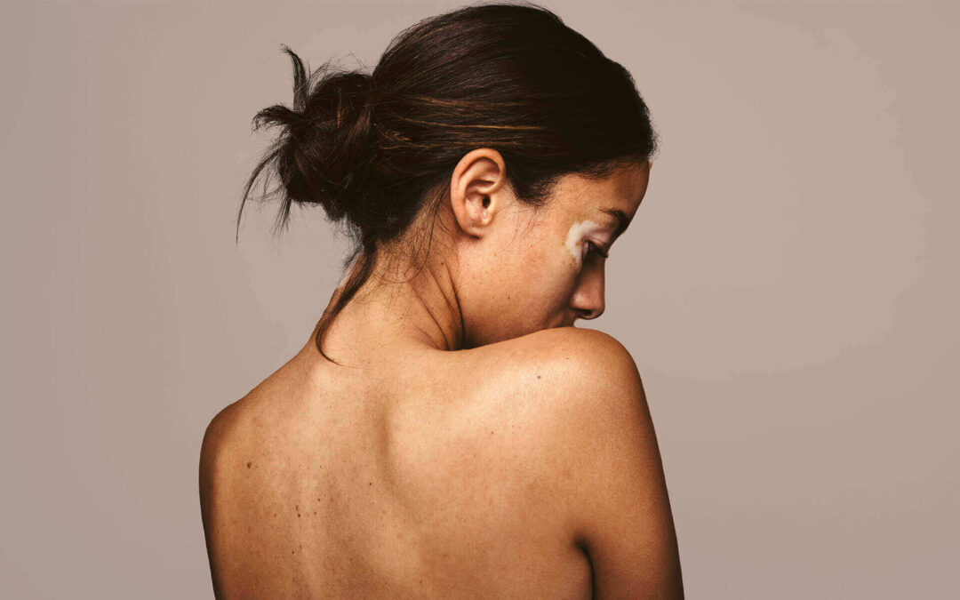 sırtta sivilce izleri nasıl geçer