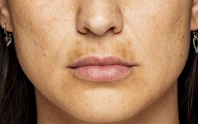 Madecassol Bıyık Lekesi İçin Etkili mi?