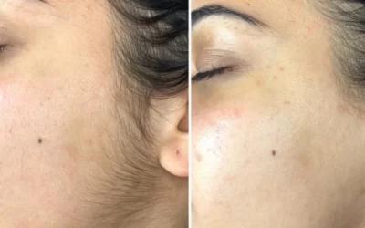 Dermaplaning ile Cilt Soyma işlemi