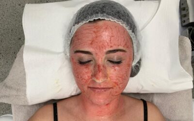 Vampire Facial Nedir? Nasıl Yapılır?