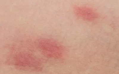 Örümcek Isırığı Nasıl Olur? Örümcek Isırığı Kaç Günde Geçer?