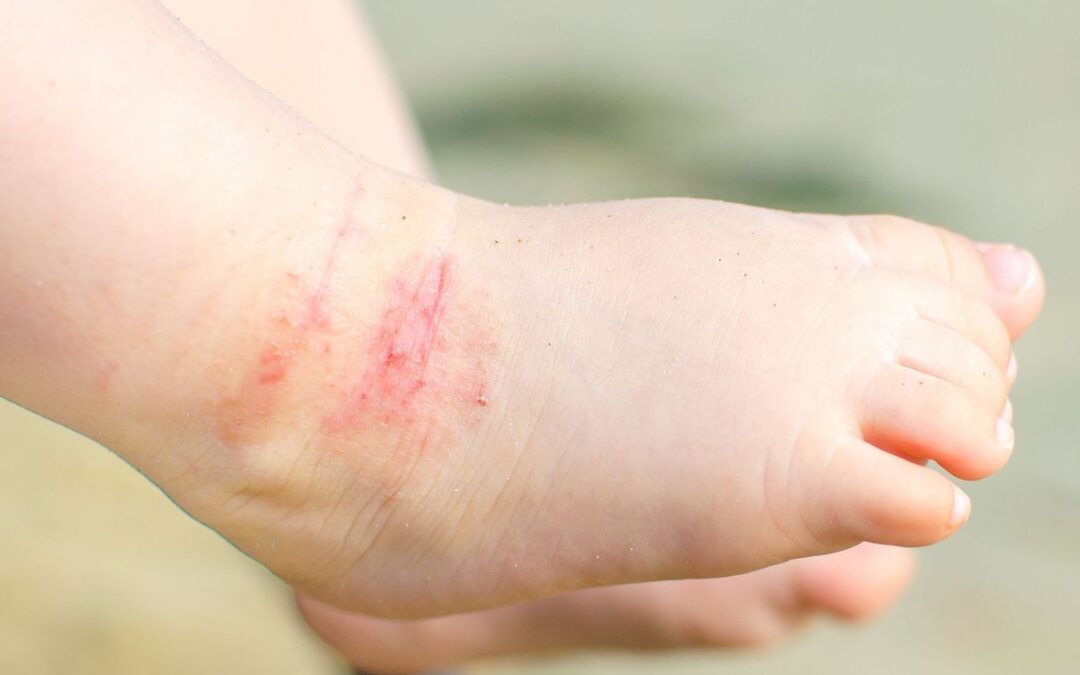 Deniz Tuzu Alerjisi Nedir, Belirtileri ve Tedavisi