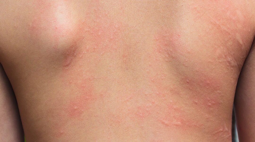 Irritan Kontakt Dermatit Nedir?