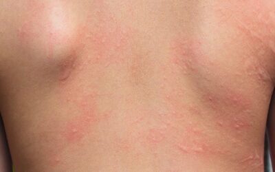 Irritan Kontakt Dermatit Nedir?