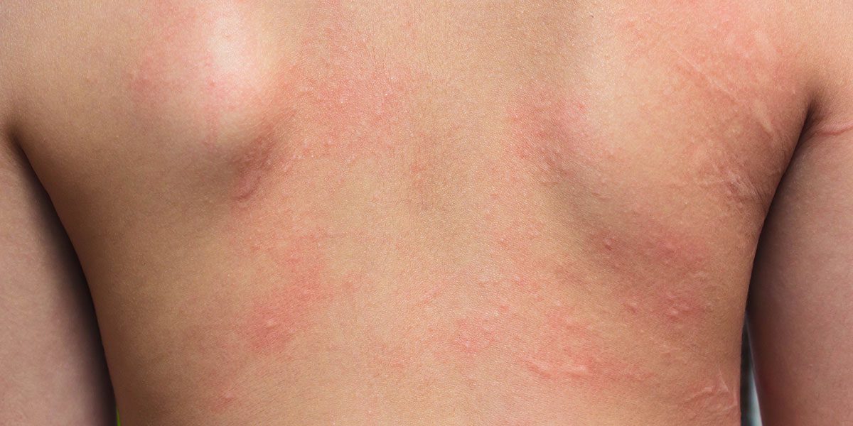 Irritan Kontakt Dermatit Nedir?