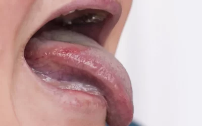 Leukoplakia Nedir?