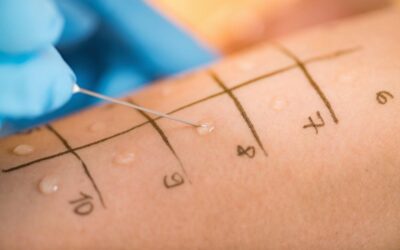 Rast Testi Nedir? Rast Testi mi Cilt Testi mi Daha İyi?