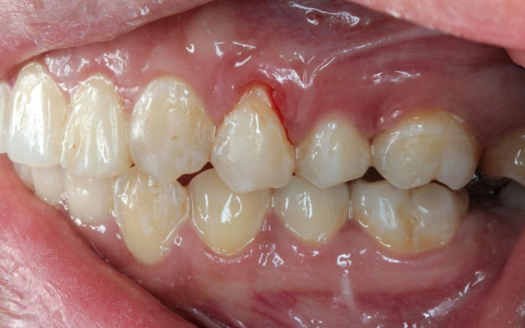 Diş eti çekilmesi Neden Olur? Ne İyi Gelir?