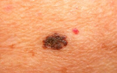Melanom Nedir? Belirtileri Neler? Melanom Kanseri