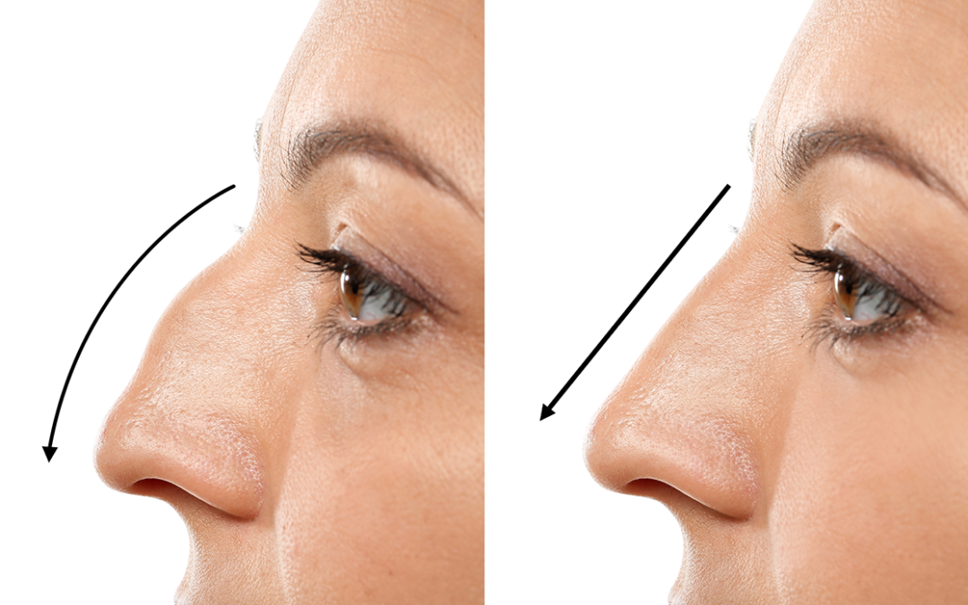 Piezo Tekniği ile Burun Estetiği Nedir?