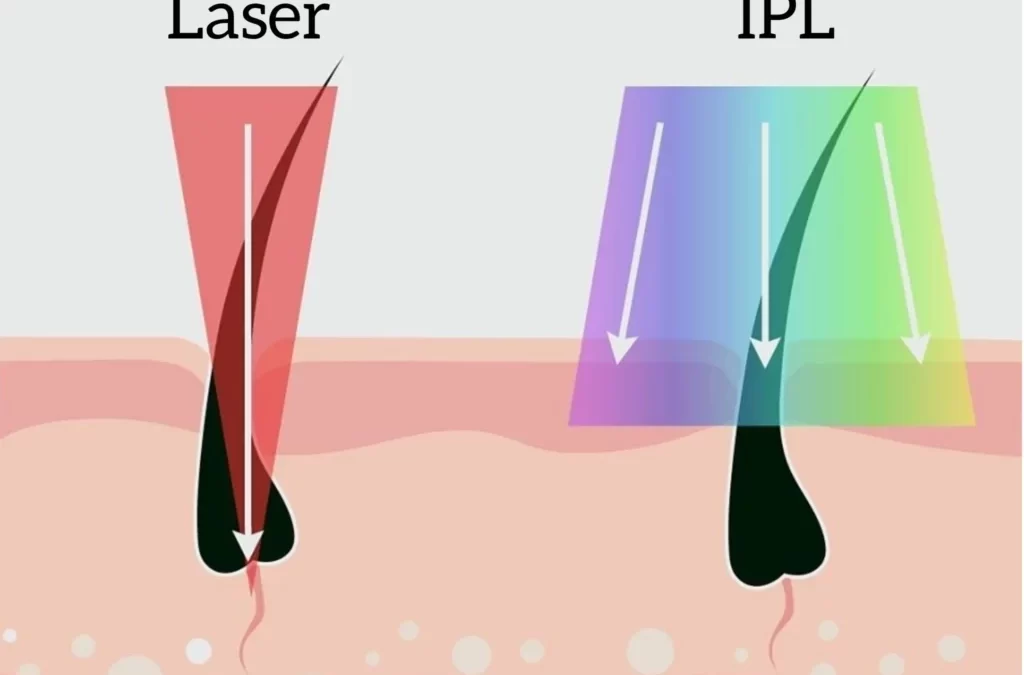 IPL ve Lazer Farkı Nedir?