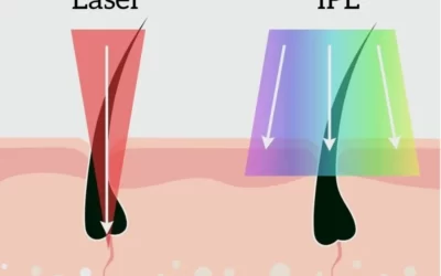 IPL ve Lazer Farkı Nedir?