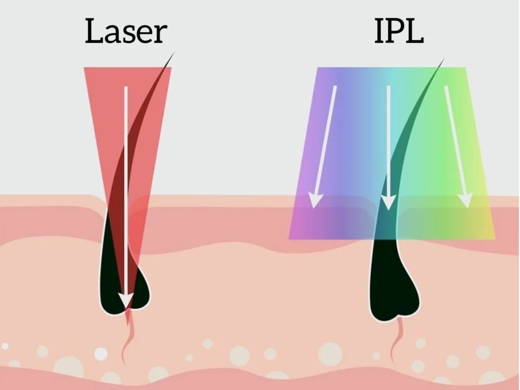 IPL ve Lazer Farkı Nedir?