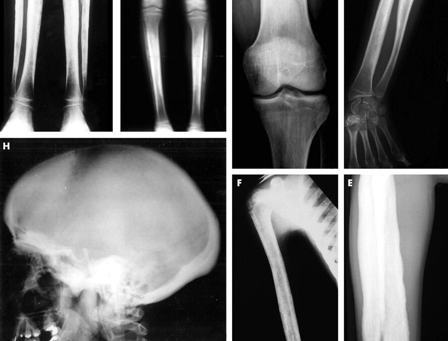 Engelmann Sendromu nedir
