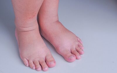 Ödem Neden Olur? Ödem Nasıl Atılır?