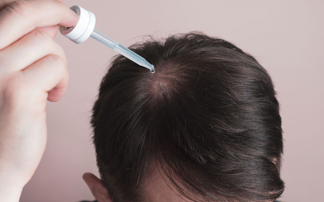 Minoxidil Nasıl Kullanılır? Nasıl Bırakılır?