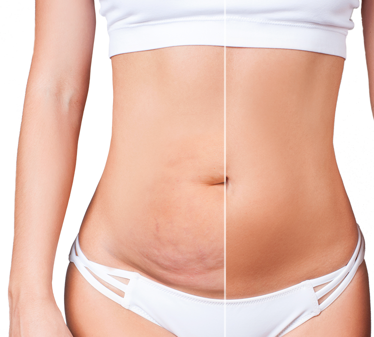 Panikülektomi Nedir?