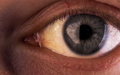 Gilbert Sendromu Nedir? Belirtileri