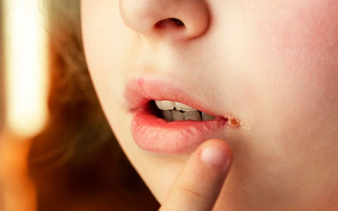 Angüler Keilit Nedir?