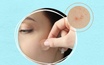 Hidrokolloidli Akne Bantları Etkili mi? İşe Yarıyor mu?