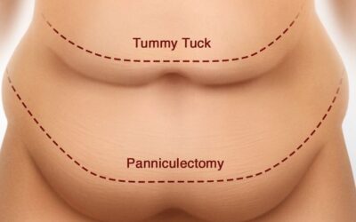 Pannikülektomi Nedir?