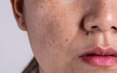 Pigmentasyon Nedir? Nasıl Önlenir?