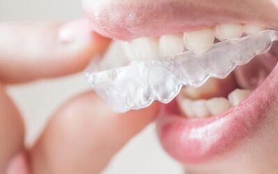 Diş Beyazlatma Jeli Nedir?